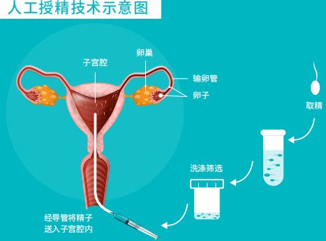 中国香港生殖医学服务有哪些? 人工授精和试管婴儿有什么区别 哪个成功率高费用低 - 好孕无忧